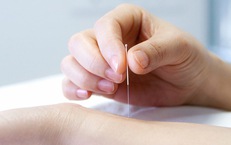 Ch&#226;m cứu điều trị vi&#234;m tuyến tiền liệt: Giải ph&#225;p Đ&#244;ng y giảm đau, ngừa t&#225;i ph&#225;t