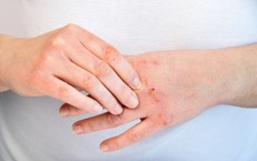 Sai lầm phổ biến khiến da bong tr&#243;c v&#224; nứt nẻ khi d&#249;ng m&#225;y sưởi m&#249;a lạnh