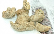 Sỏi san h&#244; trong thận l&#224; g&#236;, c&#243; nguy hiểm kh&#244;ng?