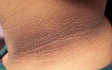 Bệnh&#160;gai&#160;đen&#160;xảy&#160;ra&#160;do&#160;nguy&#234;n&#160;nh&#226;n&#160;n&#224;o?