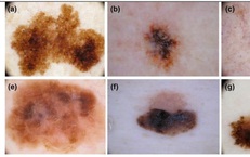 Dấu hiệu ung thư tế b&#224;o hắc tố ở da