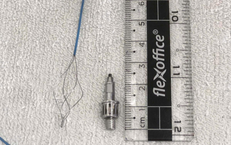 Ho k&#233;o d&#224;i sau khi l&#224;m răng, người đ&#224;n &#244;ng ph&#225;t hiện dụng cụ nha khoa trong phế quản