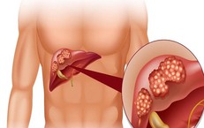 Cảnh&#160;gi&#225;c&#160;với&#160;gi&#227;n&#160;tĩnh&#160;mạch&#160;thực&#160;quản