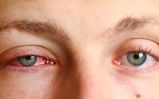 Vi&#234;m&#160;m&#224;ng&#160;bồ&#160;đ&#224;o&#160;c&#243;&#160;nguy&#160;hiểm&#160;kh&#244;ng?