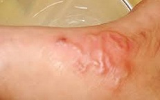 Nhiều trường hợp ở Kh&#225;nh H&#242;a bị s&#225;n ch&#243;, người d&#226;n chủ động ph&#242;ng bệnh