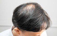 Rụng t&#243;c nhiều v&#224;o m&#249;a đ&#244;ng: B&#225;c sĩ chỉ 3 sai lầm khi gội sấy v&#224; 4 c&#225;ch khắc phục