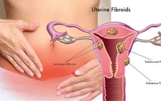 Dấu hiệu điển h&#236;nh của u xơ tử cung