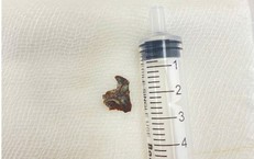 Ho khan nhiều th&#225;ng, người đ&#224;n &#244;ng bất ngờ được ph&#225;t hiện dị vật mắc s&#226;u trong đường thở