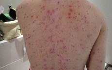 Nguy cơ biến chứng thủy đậu từ việc dùng thuốc sai cách