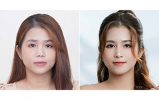 V&#236; sao nhiều người cần t&#225;i tạo mũi hỏng chỉ sau 1-2 năm?