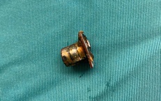 Cụm pin c&#250;c &#225;o trong thực quản b&#233; trai 2 tuổi