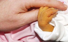 Chiếu đèn điều trị vàng da ở trẻ có hại không?