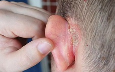 Vành tai đỏ, ngứa, khô da và bong tróc cảnh giác với bệnh chàm tai