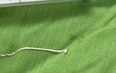 Phẫu thuật khối u, phát hiện ký sinh trùng dạng sán trong vùng hố chậu bệnh nhân