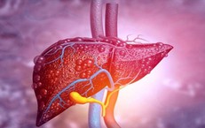 Bệnh gan nhiễm mỡ hay gặp nhưng nguy hiểm