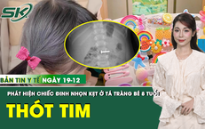 Bản Tin Y Tế 19/12: Nghịch cặp tóc, bé 8 tuổi nuốt chiếc đinh nhọn khiến cả nhà hoảng loạn