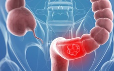 S&#224;ng lọc ph&#225;t hiện sớm ung thư đại tr&#224;ng