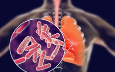 Thời gian ủ bệnh viêm phổi bao lâu?