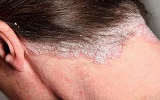 Nấm da đầu có gây rụng tóc không?