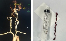 Cứu cụ bà 75 tuổi đột quỵ nhồi máu não thoát lằn ranh sinh tử