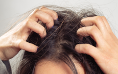 Da đầu g&#224;u – ngứa k&#233;o d&#224;i: 6 nguy&#234;n nh&#226;n &#237;t ai ngờ tới khiến vấn đề trở nặng