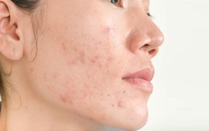 Top gel ngừa mụn được nhiều người lựa chọn trong năm 2025