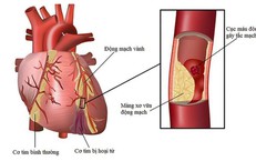 5 biện ph&#225;p giảm nguy cơ biến cố tim mạch khi thời tiết lạnh