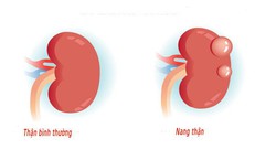 Nang thận c&#243; thật sự l&#224;nh t&#237;nh? Chuy&#234;n gia cảnh b&#225;o những dấu hiệu tuyệt đối kh&#244;ng được bỏ qua