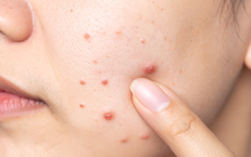 V&#236; sao phụ nữ m&#227;n kinh vẫn bị mụn?