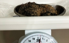 Nửa c&#226;n t&#243;c trong dạ d&#224;y b&#233; g&#225;i 6 tuổi 