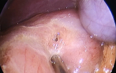 Phẫu thuật cấp cứu bệnh nhi 13 tuổi bị thủng ổ lo&#233;t dạ d&#224;y – t&#225; tr&#224;ng v&#224; lời cảnh tỉnh từ b&#225;c sĩ