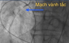 Cứu sống bệnh nh&#226;n 70 tuổi v&#236; nhầm nhồi m&#225;u cơ tim với &#39;tr&#250;ng gi&#243;&#39;