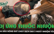 Da đầu n&#243;ng r&#225;t chảy dịch sau ba ng&#224;y nhuộm đổi m&#224;u t&#243;c