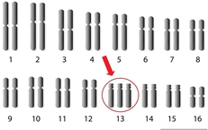 6 c&#226;u hỏi thường gặp về hội chứng Patau