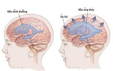 C&#226;u hỏi thường gặp li&#234;n quan đến bệnh gi&#227;n n&#227;o thất