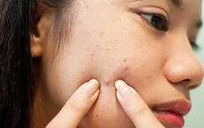Sau nặn mụn kh&#244;ng n&#234;n ăn g&#236;?