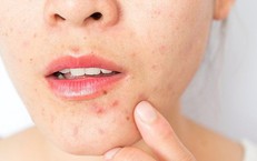 Mụn trứng c&#225; c&#243; tự chữa được kh&#244;ng?
