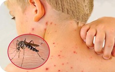 C&#225;ch ph&#225;t hiện sớm sốt xuất huyết diễn biến nặng