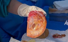 Điều trị co thắt bao xơ sau n&#226;ng ngực