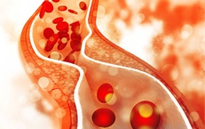 Tại sao chỉ số cholesterol vẫn cao d&#249; ăn uống điều độ v&#224; tập thể dục thường xuy&#234;n?