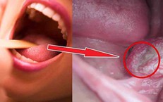 Dấu hiệu điển h&#236;nh của ung thư khoang miệng ở giai đoạn sớm
