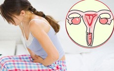 5 dấu hiệu nghi ngờ ung thư cổ tử cung chị em cần biết