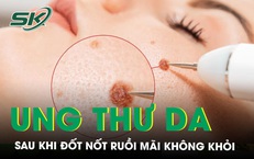 Đốt nốt ruồi ở nước ngo&#224;i m&#227;i kh&#244;ng khỏi, về Việt Nam ph&#225;t hiện mắc ung thư