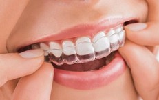 Loại mắc c&#224;i n&#224;o tốt nhất để niềng răng?