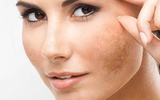 Uống g&#236; để đẹp da, giảm n&#225;m cho phụ nữ sau tuổi 30?