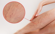 Suy gi&#227;n tĩnh mạch tiến triển: Đừng chủ quan với những dấu hiệu ban đầu