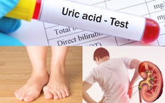 4 b&#224;i tập đơn giản gi&#250;p hạ axit uric ngăn ngừa mắc gout (g&#250;t)