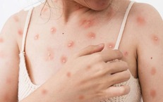 Cảnh báo thủy đậu ở người lớn có thể gây biến chứng nguy hiểm