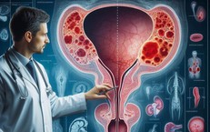 Tiểu máu, sụt cân... cảnh giác với ung thư bàng quang