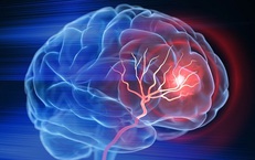 Áp lực, cường độ làm việc cao kéo dài có làm tăng nguy cơ đột quỵ ở người trẻ?